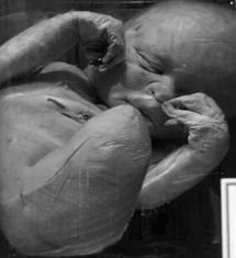 Baby born with limb deformities